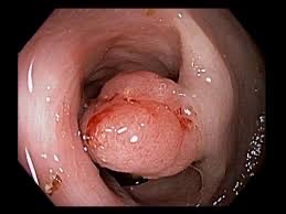Endoscopic colorectal cancer example