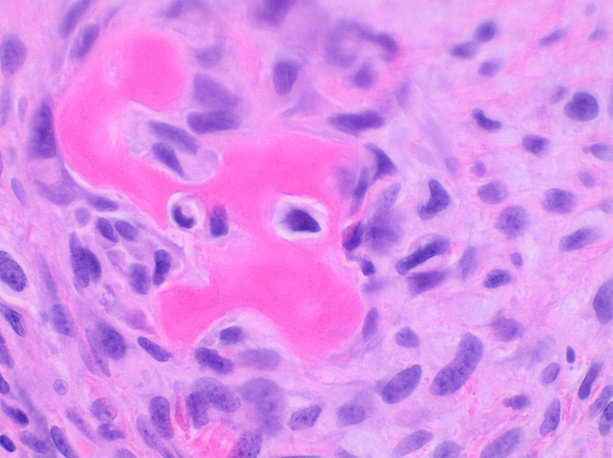 Osteosarcoma histology