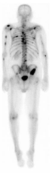 Metastatic bone scan