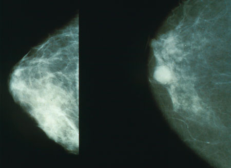 Mammogram image showing breast cancer