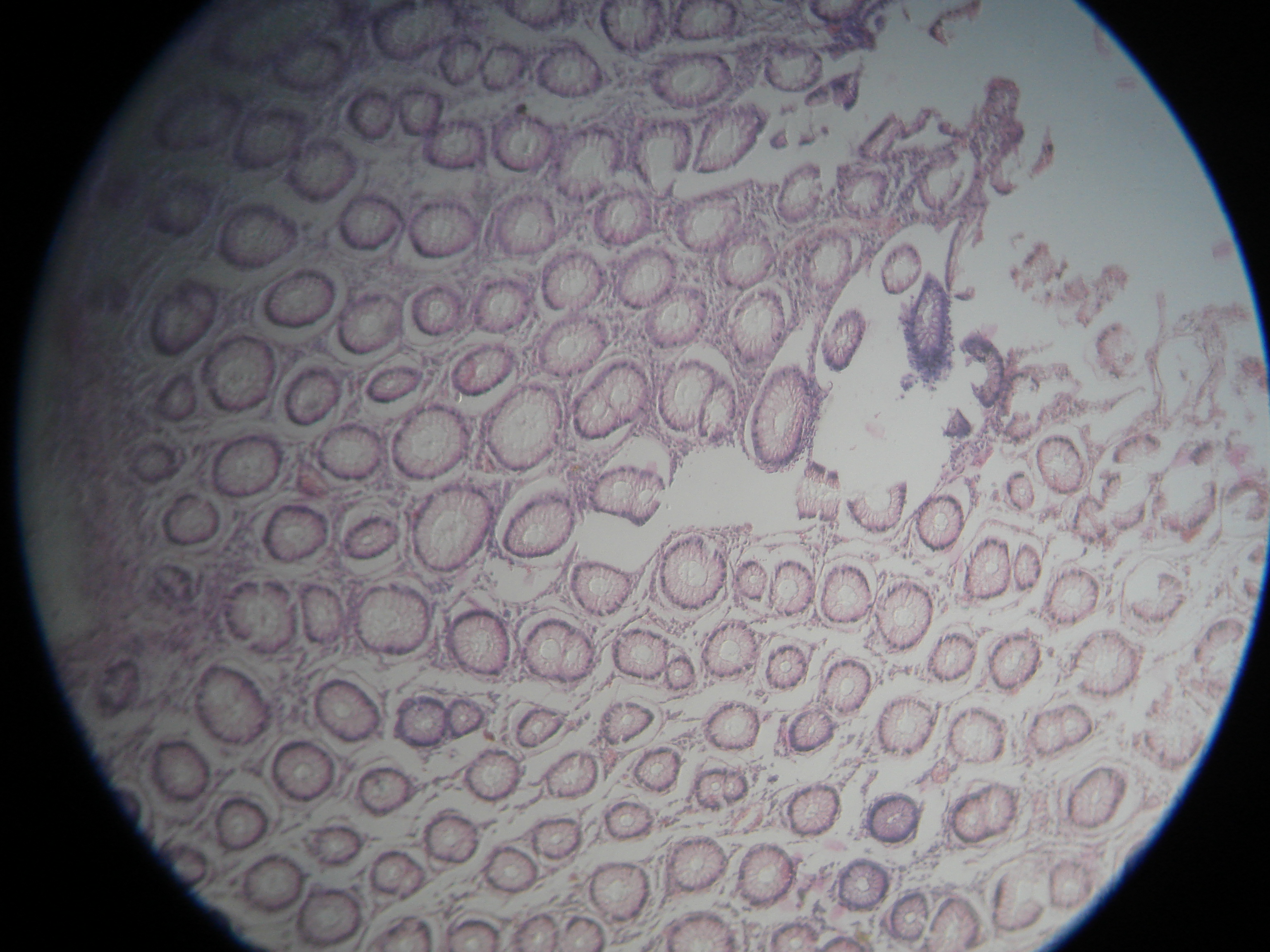 Colon adenocarcinoma histology slide