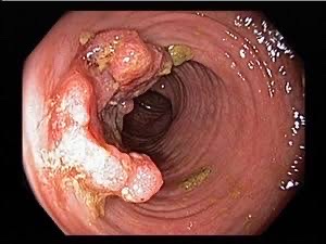 Colonoscopy image of colon polyps