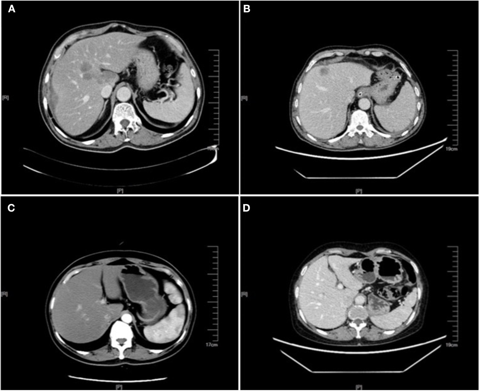 CT image of colorectal liver metastases