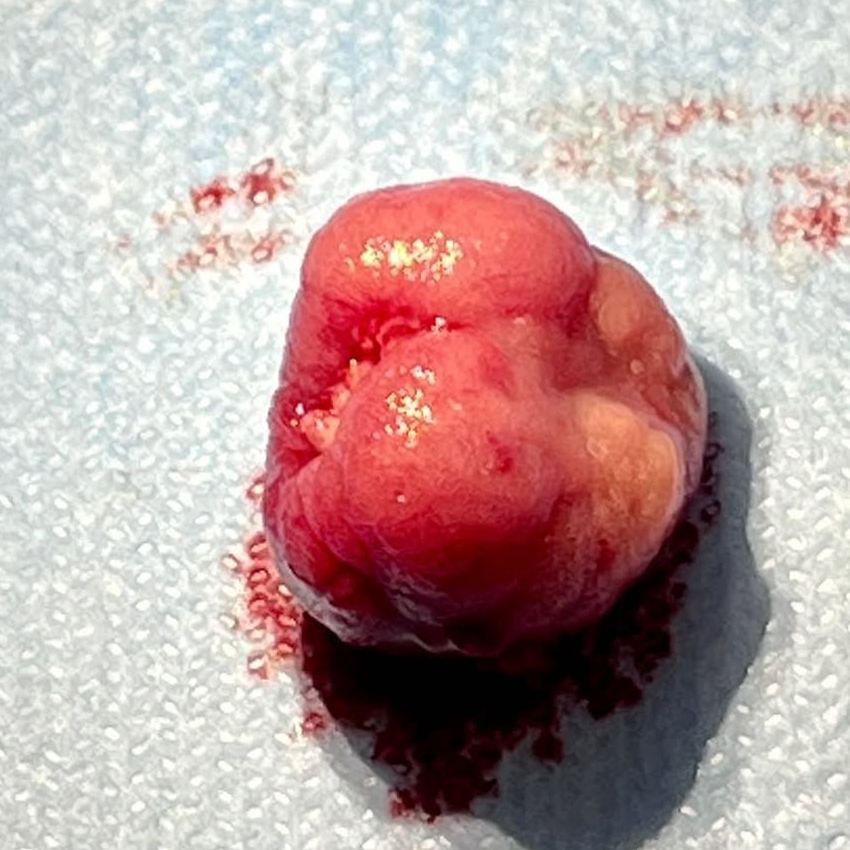 Removed colon polyp specimen after colonoscopy