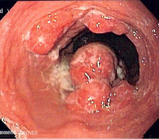 Esophageal adenocarcinoma endoscopy