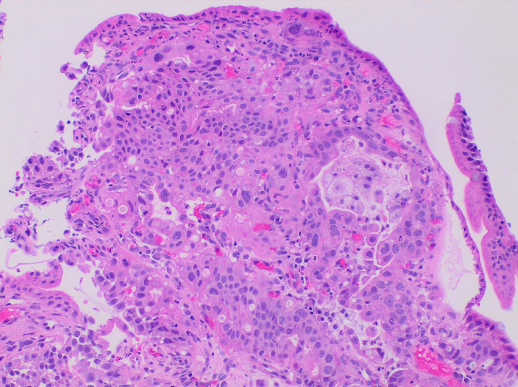 Esophageal adenocarcinoma histology