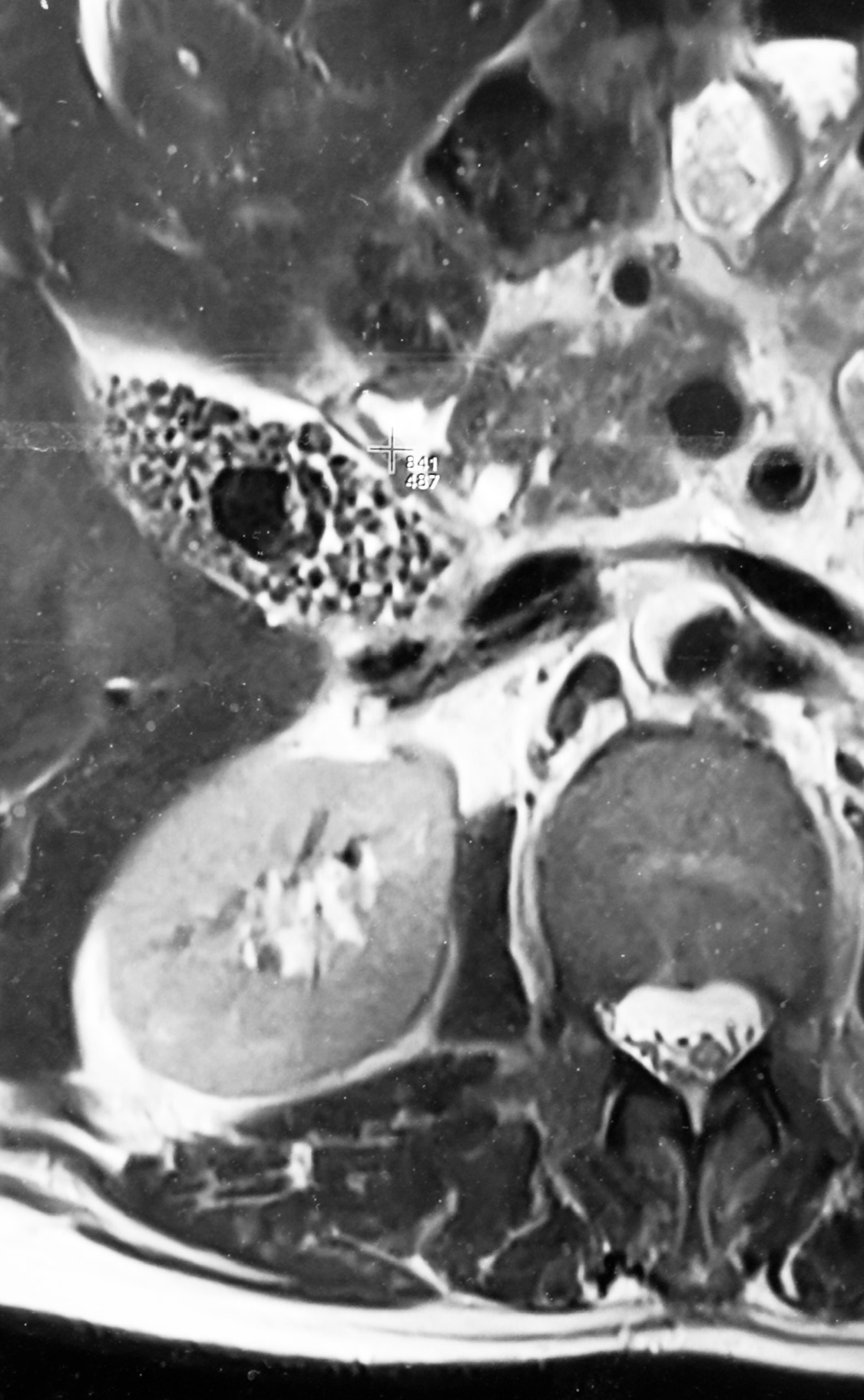 Gallbladder ultrasound scan