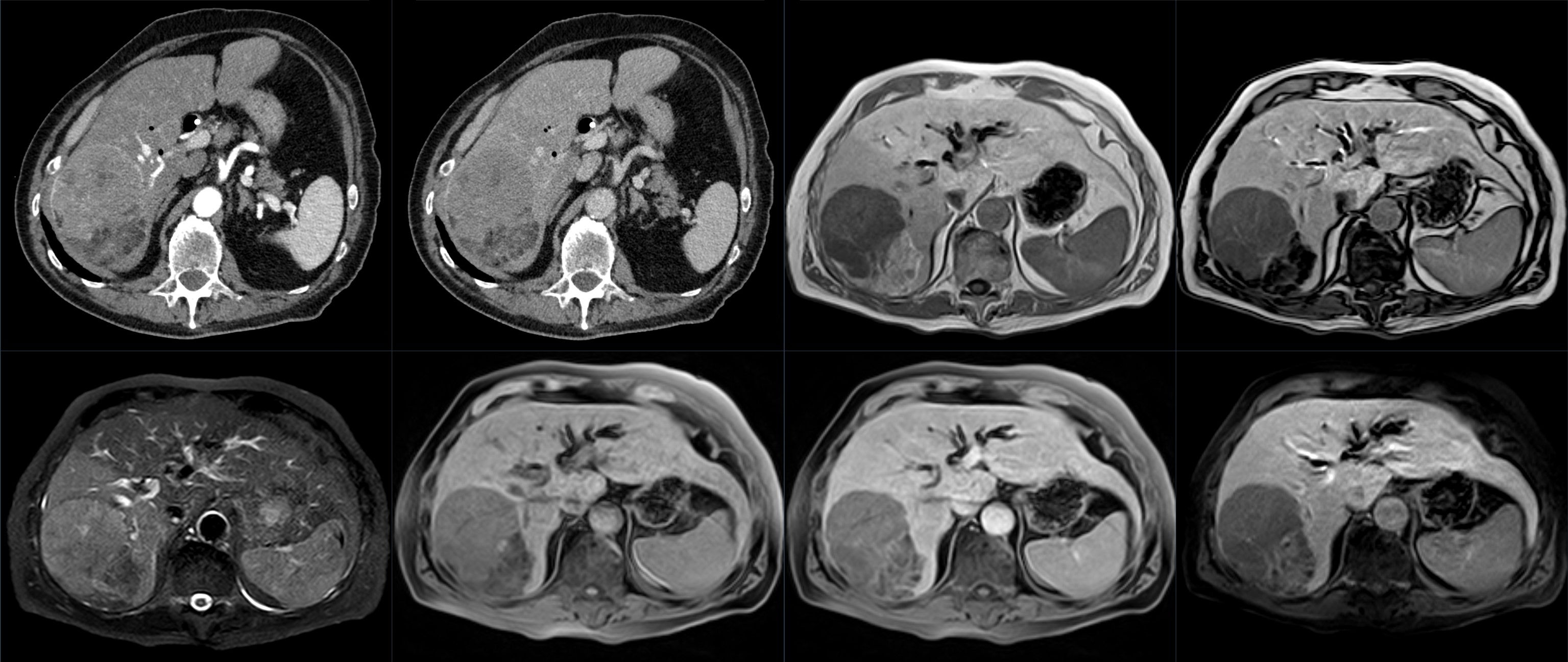 Liver cancer cross-sectional imaging