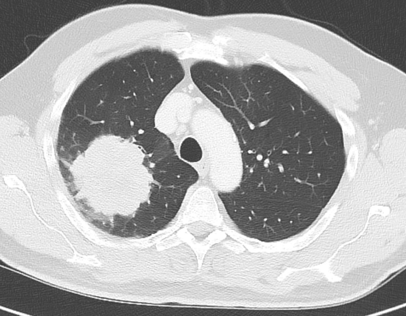 CT image of lung adenocarcinoma