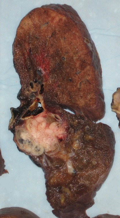 Gross pneumonectomy specimen with lung cancer.