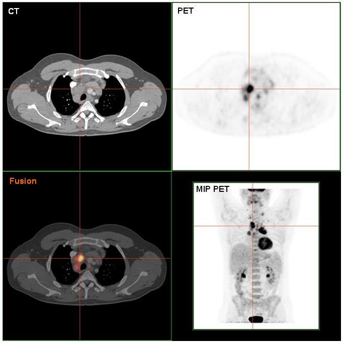 PET-CT in lymphoma