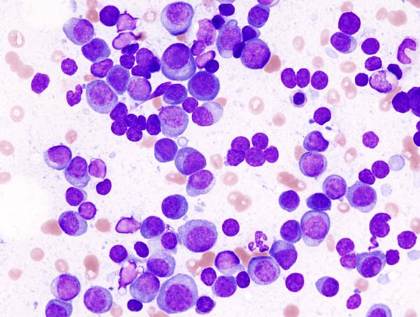 Myeloma bone marrow smear