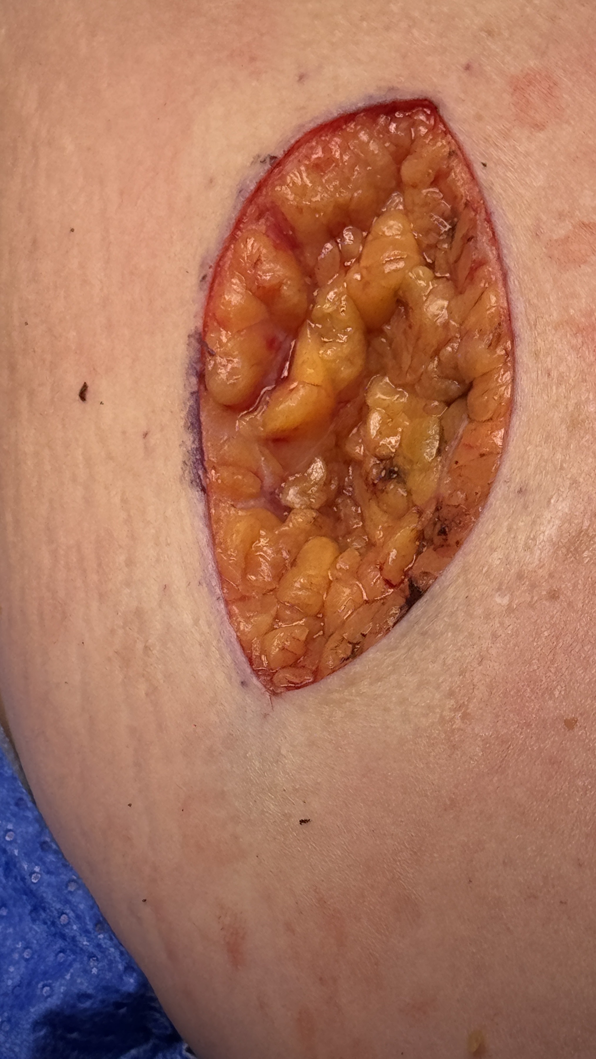 Biopsy/excision example