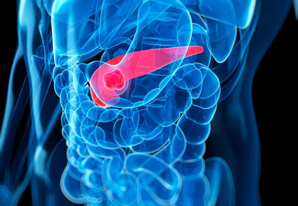 Illustration of pancreatic cancer in the pancreas