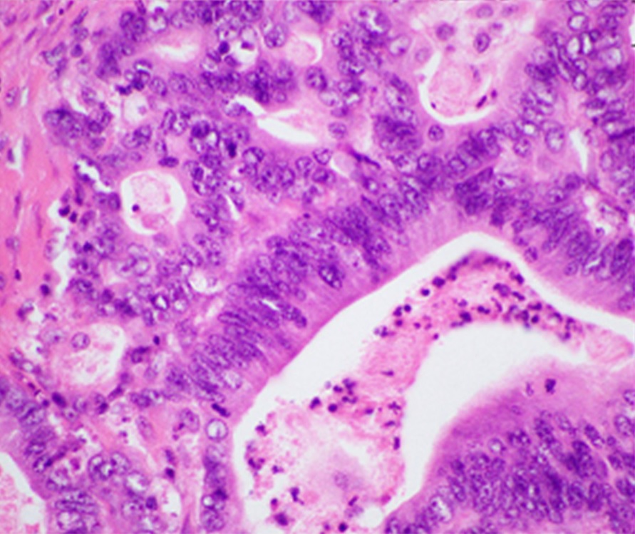 Pancreatic cancer histology