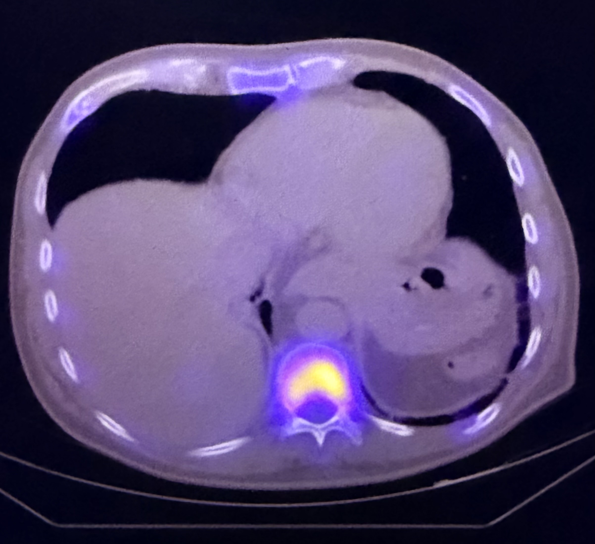 PET-CT example