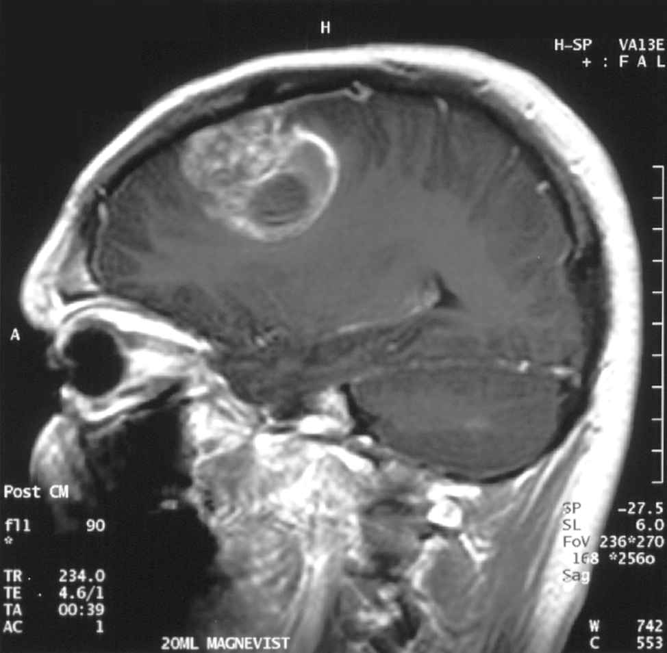 Brain MRI example