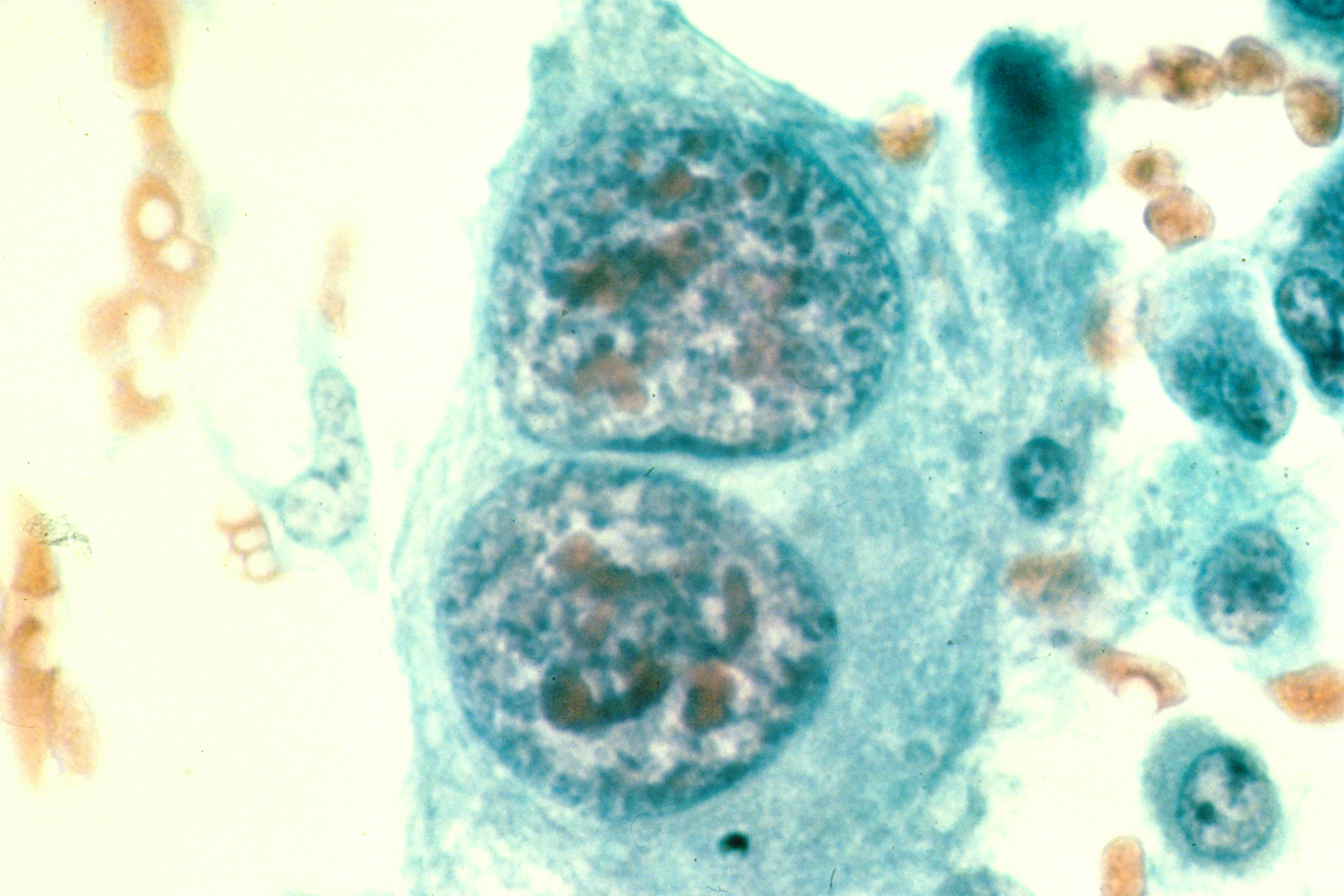 Sarcoma cytology example