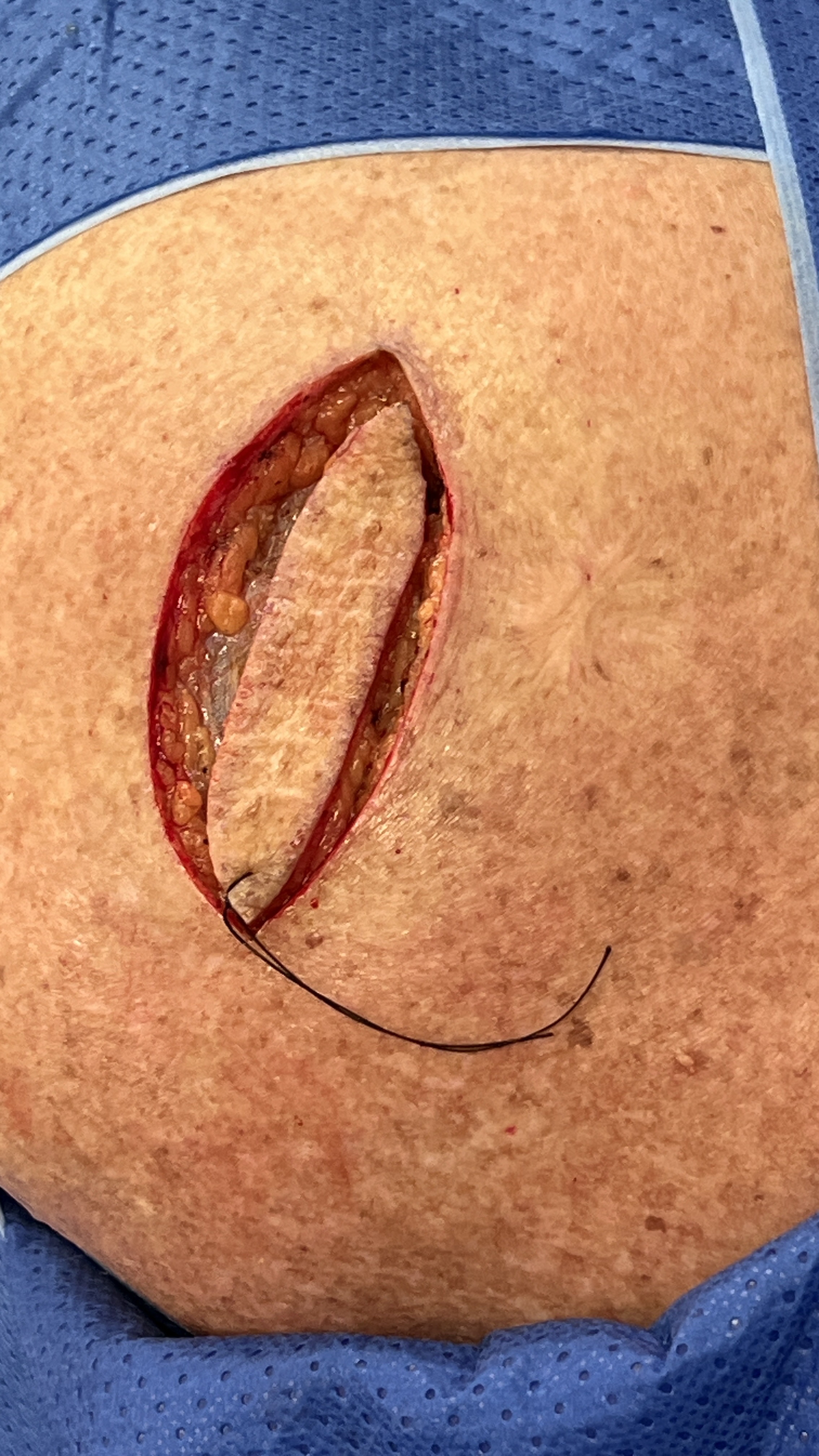 Skin cancer excision closure