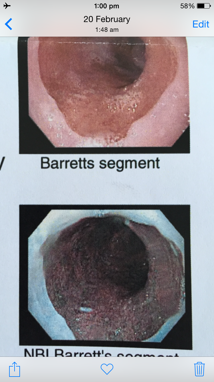Upper GI endoscopy image.