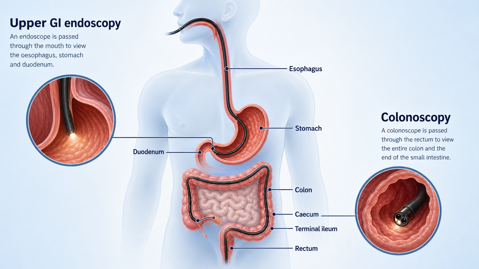 Upper endoscopy visual for stomach cancer detection