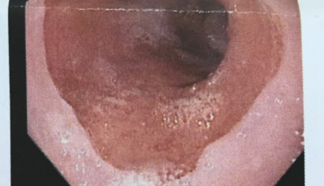 Upper GI gastroscopy mucosa image.