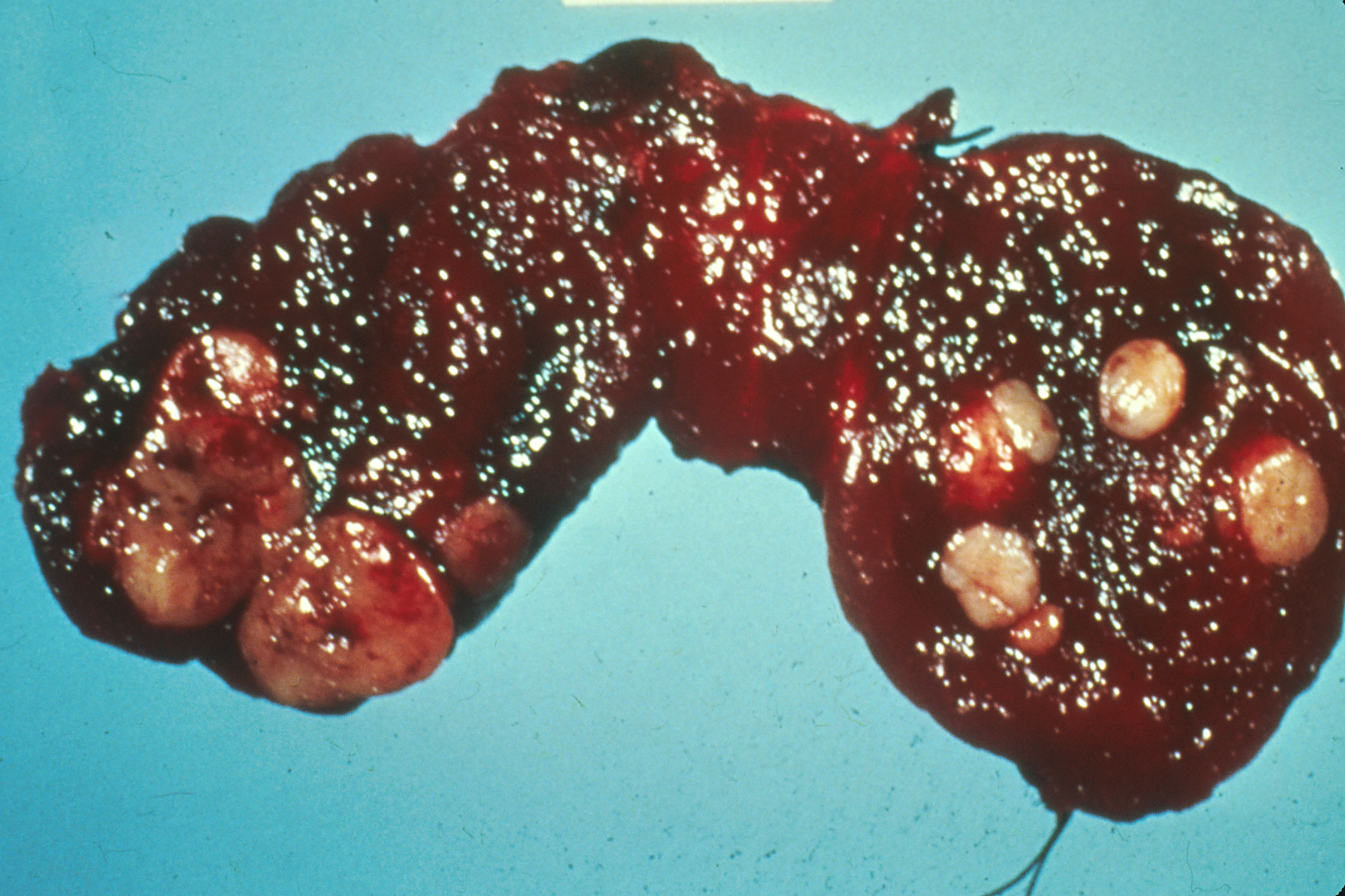 Gross thyroid cancer specimen.